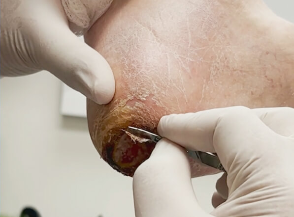 Amniotic membrane using for leg