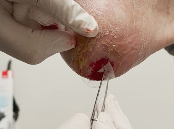 Amniotic membrane using for leg