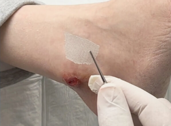 Amniotic membrane using for leg