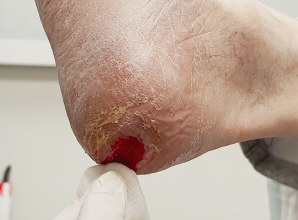 Amniotic membrane using for leg